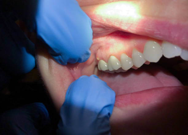 Best Emergency Tooth Extraction in Rochester, IN